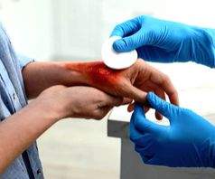 No ice, no toothpaste for burn injuries, say KGMU experts