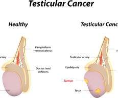 Why young men must be aware of testicular cancer